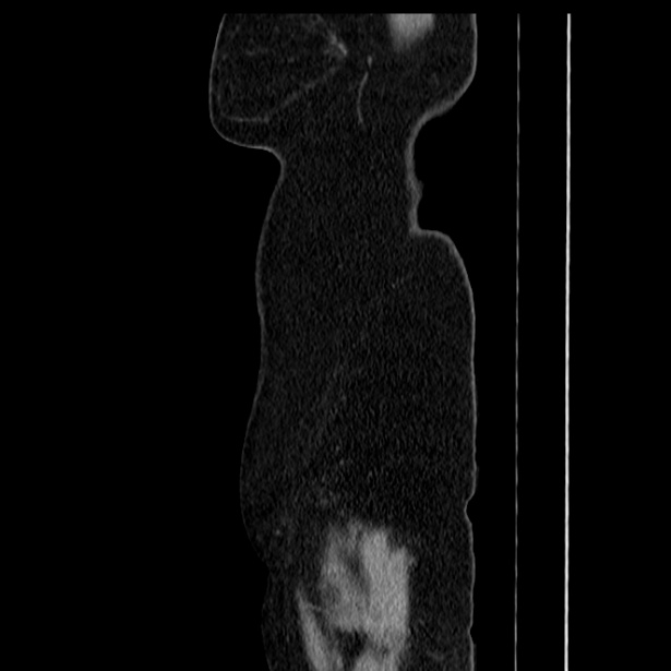 Acute pancreatitis - Balthazar C (Radiopaedia 26569-26714 Sagittal C+ portal venous phase 66).jpg