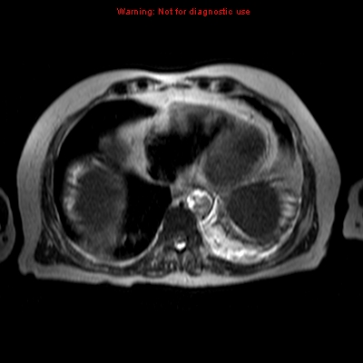 File:Acute pancreatitis with incidental pancreatic lipoma (Radiopaedia 10190-10732 Axial T2 26).jpg