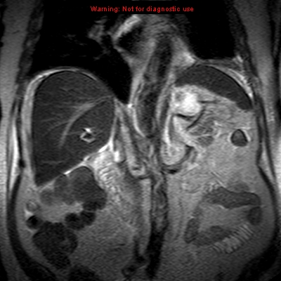 File:Acute pancreatitis with incidental pancreatic lipoma (Radiopaedia 10190-10732 Coronal T2 18).jpg