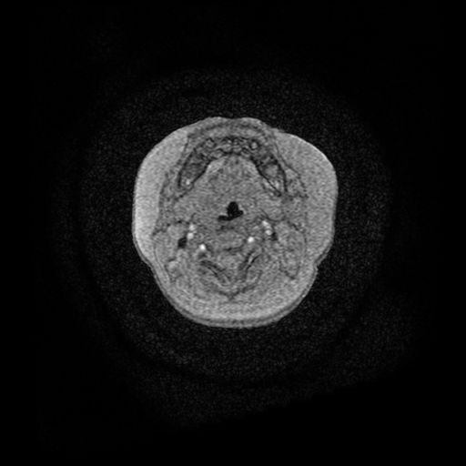 Acute phase of hemiconvulsion-hemiplegia epilepsy syndrome (Radiopaedia 29309-29745 Axial TOF angiography 189).jpg