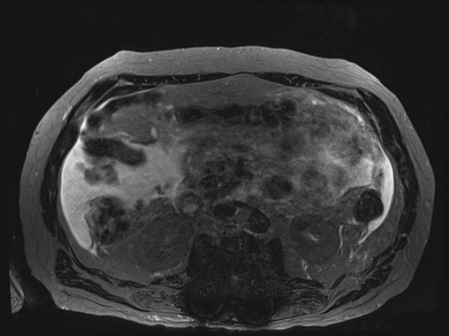 Acute portal vein thrombosis (Radiopaedia 73198-83925 Axial Heavily T2 thin cuts 56).jpg