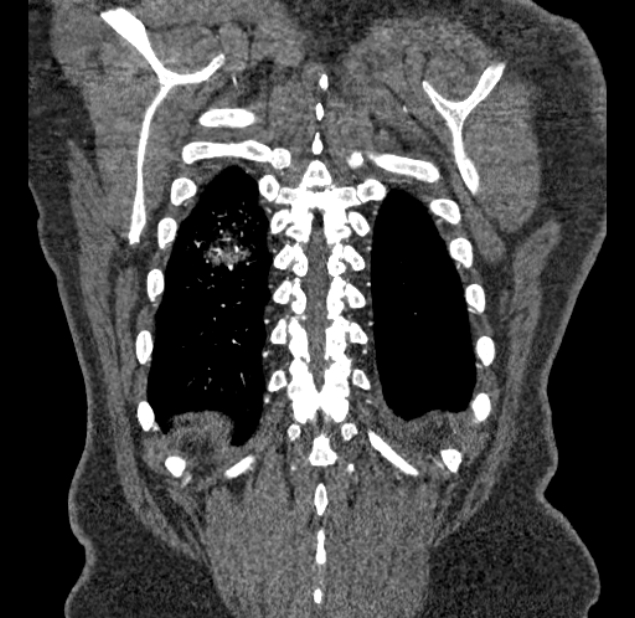 Acute pulmonary embolism with pulmonary infarcts (Radiopaedia 77688-89908 Coronal C+ CTPA 96).jpg
