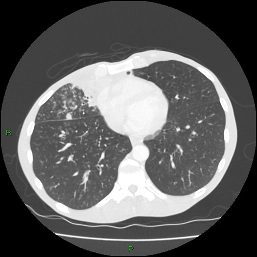 Acute right lung abscess (Radiopaedia 34806-36258 Axial lung window 129).jpg
