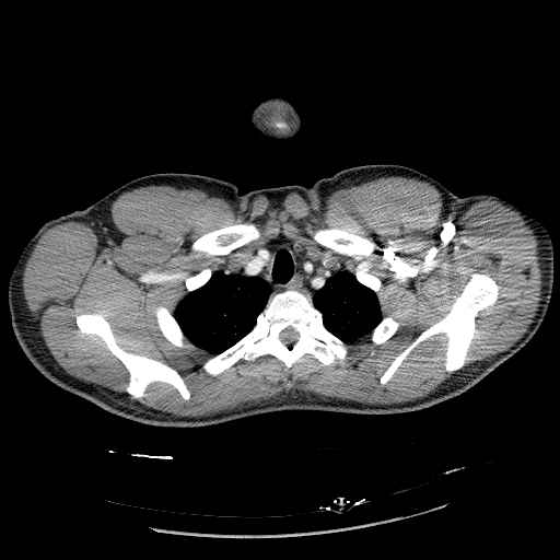 Acute segmental pulmonary emboli and pulmonary infarction (Radiopaedia 62264-70444 Axial C+ CTPA 18).jpg