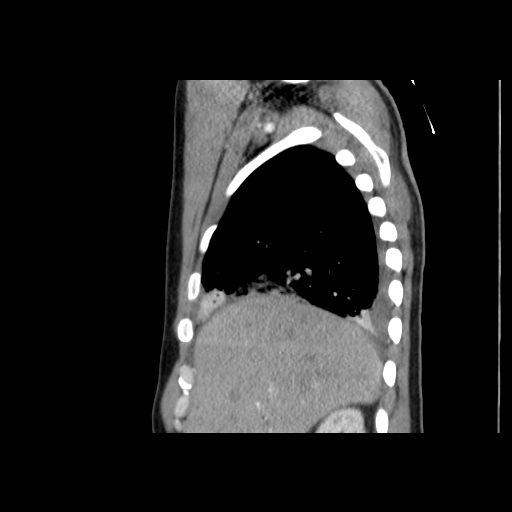 Acute segmental pulmonary emboli and pulmonary infarction (Radiopaedia 62264-70444 Sagittal C+ CTPA 17).jpg