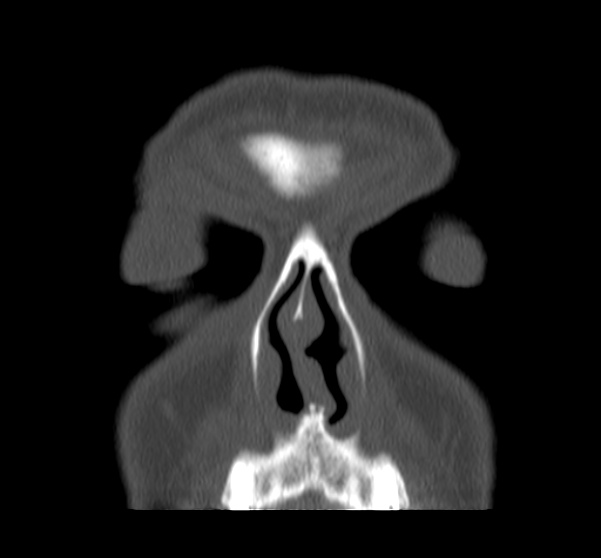 Acute sinusitis (Radiopaedia 23161-23215 Coronal bone window 19).jpg