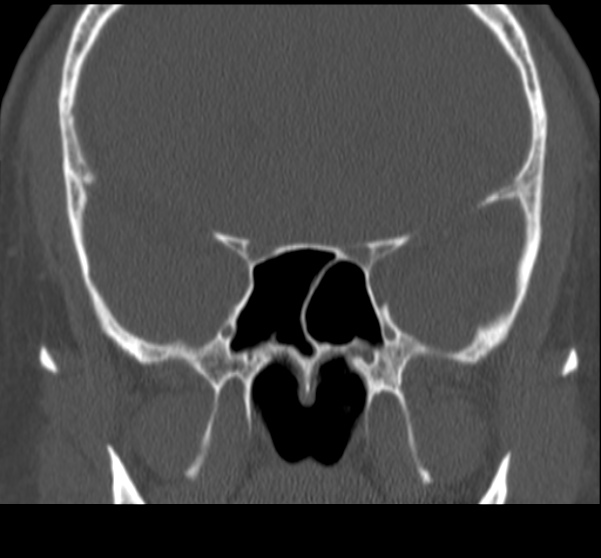 File:Acute sinusitis (Radiopaedia 23161-23215 Coronal bone window 47).jpg