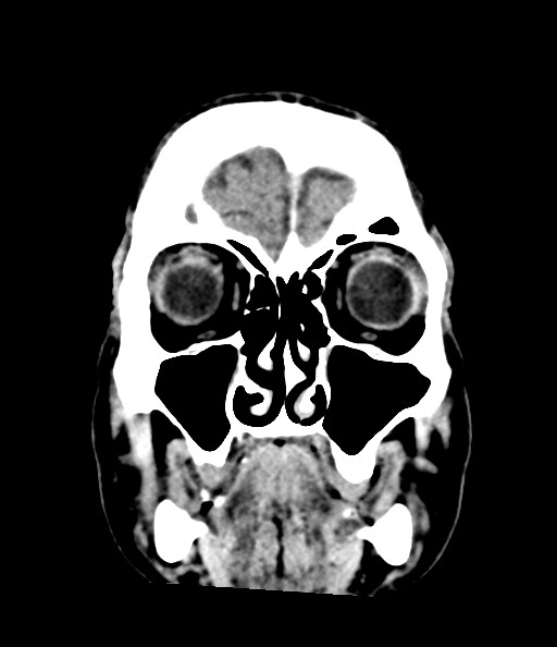 Acute superior cerebellar artery territory infarct (Radiopaedia 84104-99359 Coronal non-contrast 26).jpg