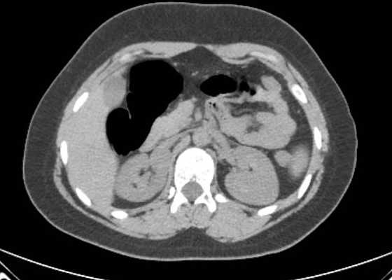 Acute unilateral nonhemorrhagic adrenal infarction (Radiopaedia 67560-76957 Axial non-contrast 53).jpg