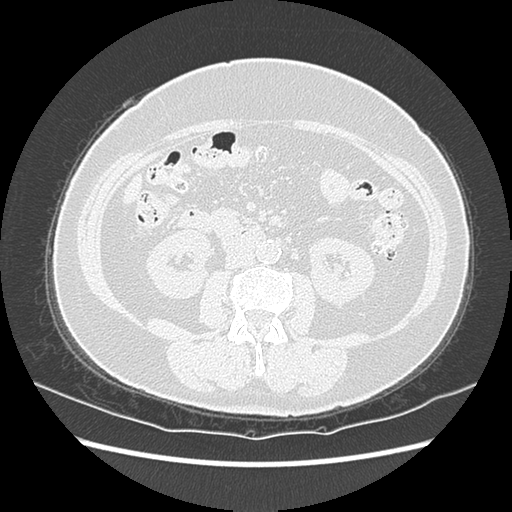 Adenocarcinoma in situ of lung (Radiopaedia 38685-40829 B 278).png
