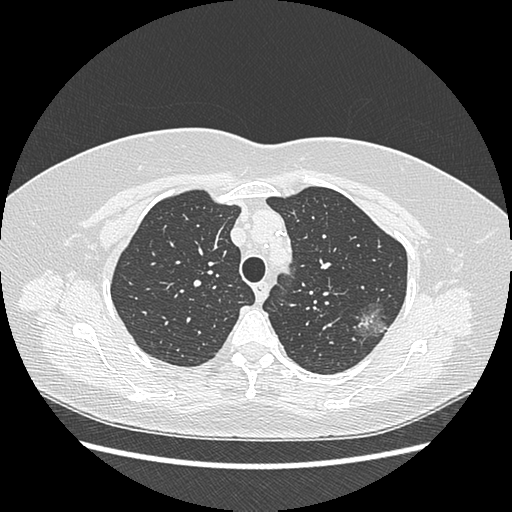 Adenocarcinoma in situ of lung (Radiopaedia 38685-40829 B 58).png