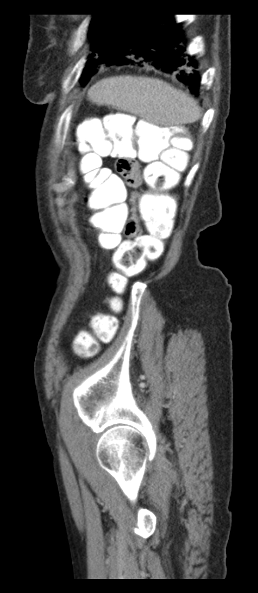 Adenocarcinoma of cecum (Radiopaedia 59222-66549 Sagittal C+ portal venous phase 4).jpg