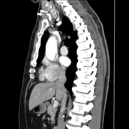Adenocarcinoma of the lung (Radiopaedia 59871-67325 Sagittal C+ arterial phase 46).jpg
