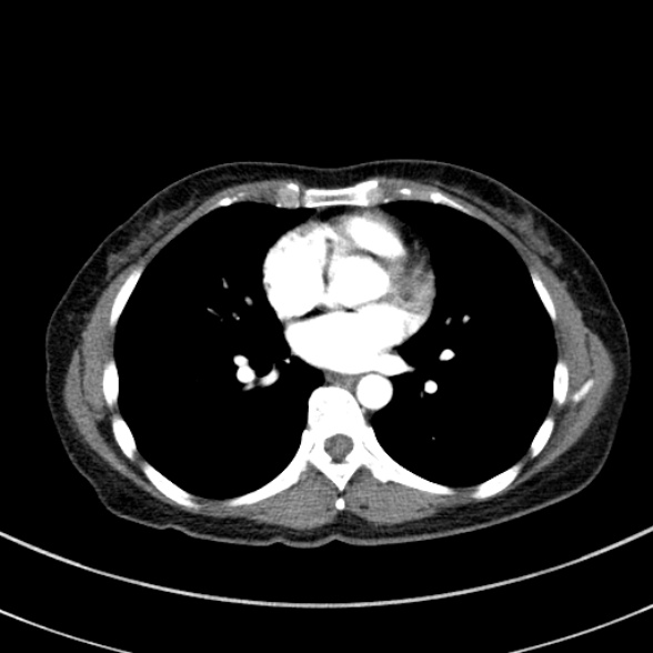 File:Adenocystic carcinoma of the trachea (Radiopaedia 47677-52525 Axial C+ arterial phase 56).jpg