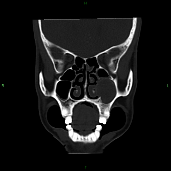 File:Adenoid cystic carcinoma of hard palate (Radiopaedia 26137-26273 Coronal bone window 9).jpg