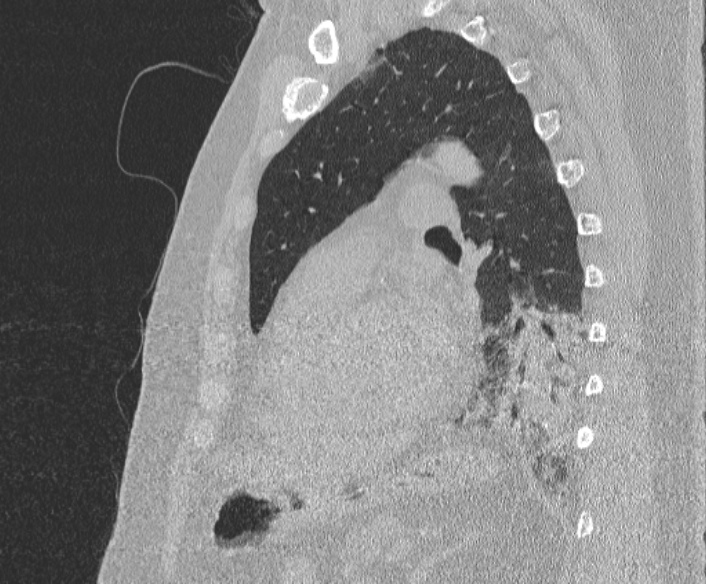 Adenoid cystic carcinoma of the trachea (Radiopaedia 49042-54137 Sagittal lung window 296).jpg