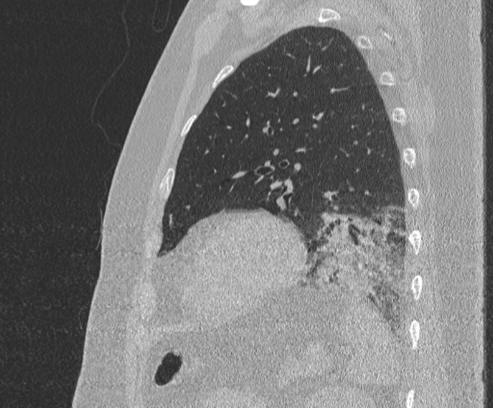 Adenoid cystic carcinoma of the trachea (Radiopaedia 49042-54137 Sagittal lung window 348).jpg