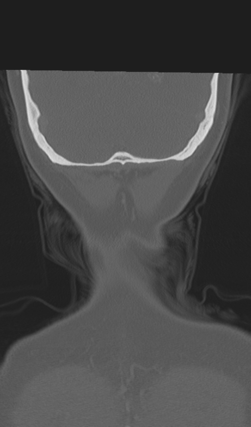 Adenoid cystic tumor of palate (Radiopaedia 46980-51518 Coronal bone window 57).png