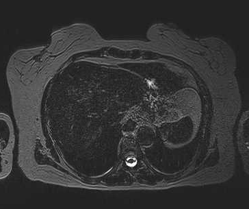 File:Adenomyomatosis of the gallbladder (Radiopaedia 50246-55587 Axial 117).png
