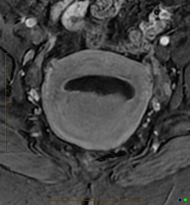 Adenomyosis uterus with hematometra (Radiopaedia 45779-50011 Axial T1 C+ fat sat 30).jpg