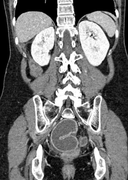 Adhesional small bowel obstruction (Radiopaedia 48397-53305 Coronal C+ portal venous phase 261).jpg