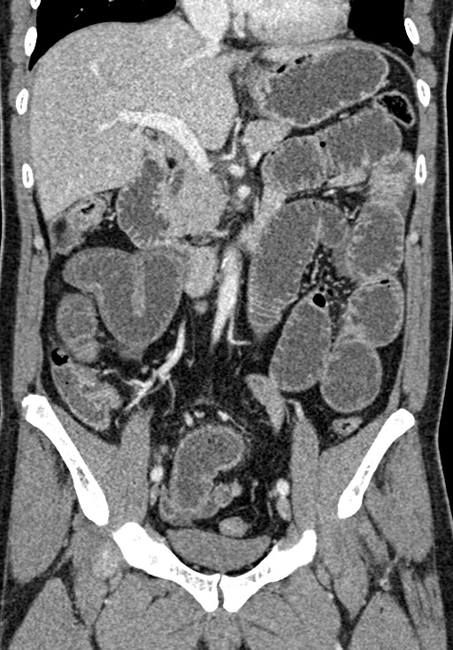Adhesional small bowel obstruction (Radiopaedia 58900-66131 Coronal C+ portal venous phase 133).jpg