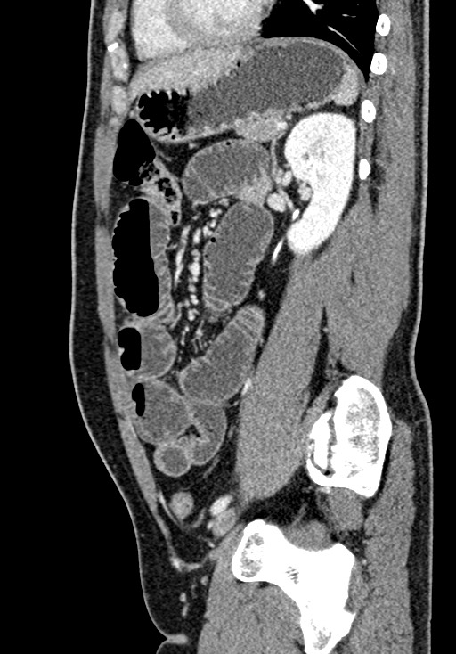 Adhesional small bowel obstruction (Radiopaedia 58900-66131 Sagittal C+ portal venous phase 165).jpg