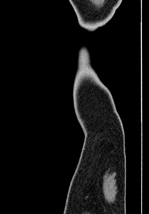 Adhesional small bowel obstruction (Radiopaedia 58900-66131 Sagittal C+ portal venous phase 255).jpg