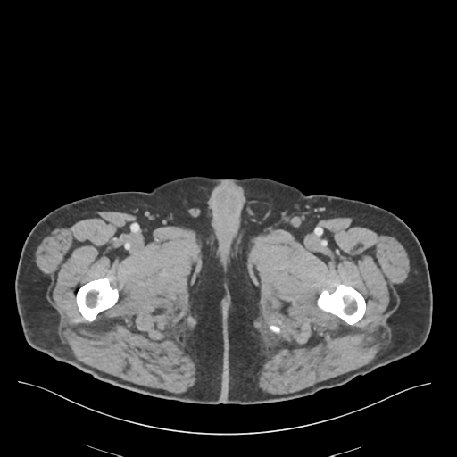 Adhesions within abdominal wall hernia (Radiopaedia 58283-65394 Axial C+ portal venous phase 95).png