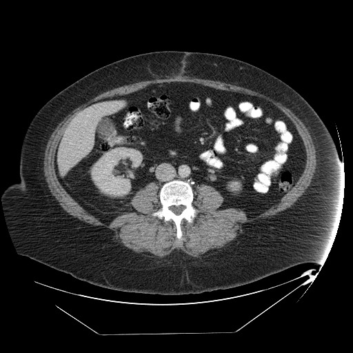 Adrenal angiosarcoma (Radiopaedia 81081-94671 Axial C+ portal venous phase 46).jpg
