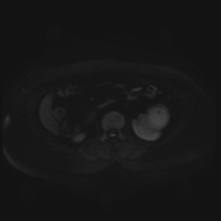 Adrenal cortical carcinoma (Radiopaedia 70906-81116 Axial DWI 48).jpg