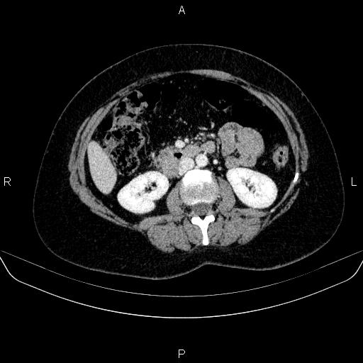 File:Adrenal cortical carcinoma (Radiopaedia 84882-100379 Axial C+ portal venous phase 42).jpg