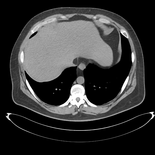 Adrenal cyst (Radiopaedia 45625-49778 Axial non-contrast 5).png