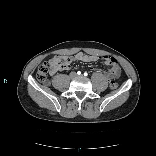 Adrenal cystic lymphangioma (Radiopaedia 83161-97534 Axial C+ arterial phase 63).jpg