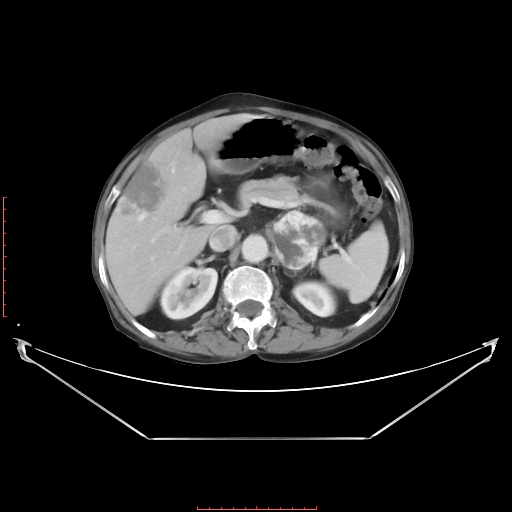 File:Adrenal hemangioma (Radiopaedia 68923-78668 Axial C+ portal venous phase 26).jpg