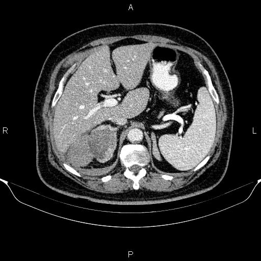 Adrenal hemorrhage (Radiopaedia 62622-70916 Axial C+ portal venous phase 45).jpg
