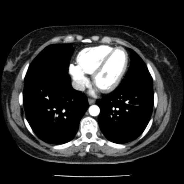 Adrenal myelolipoma (Radiopaedia 43401-46759 Axial C+ arterial phase 1).jpg
