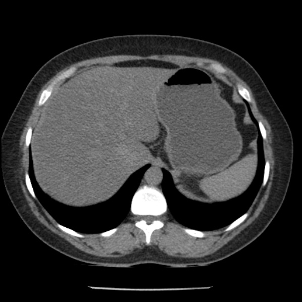 File:Adrenal myelolipoma (Radiopaedia 43401-46759 Axial non-contrast 16).jpg