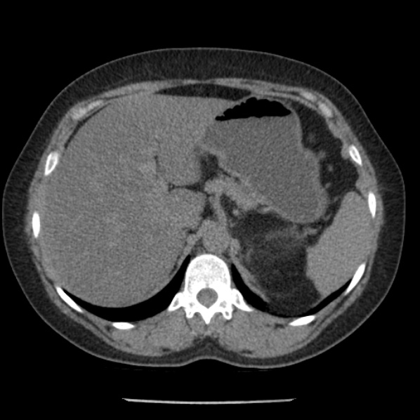 Adrenal myelolipoma (Radiopaedia 43401-46759 Axial non-contrast 21).jpg