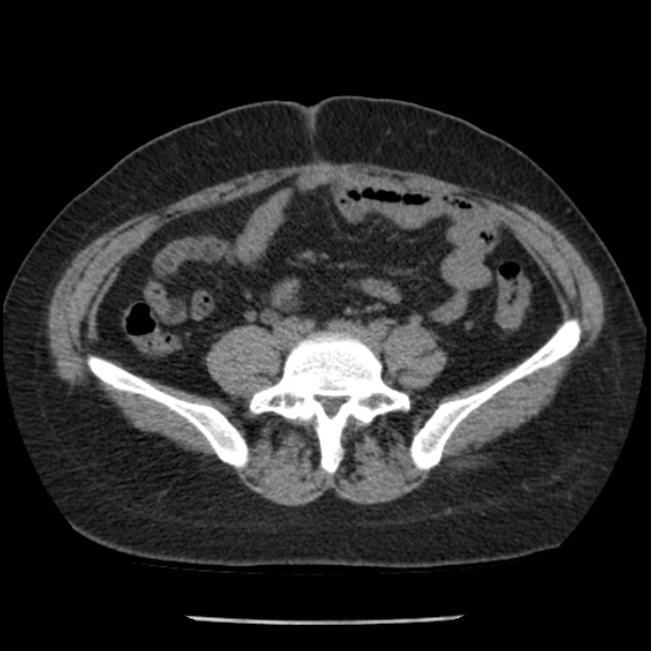 Adrenal myelolipoma (Radiopaedia 43401-46759 Axial non-contrast 58).jpg