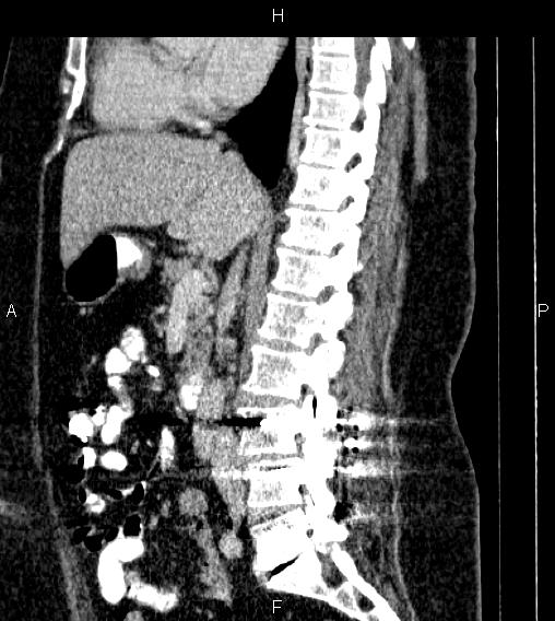 Adrenal myelolipoma (Radiopaedia 84319-99617 Sagittal renal cortical phase 45).jpg