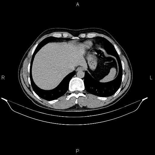Adrenal myelolipoma (Radiopaedia 87794-104246 Axial renal excretory phase 13).jpg