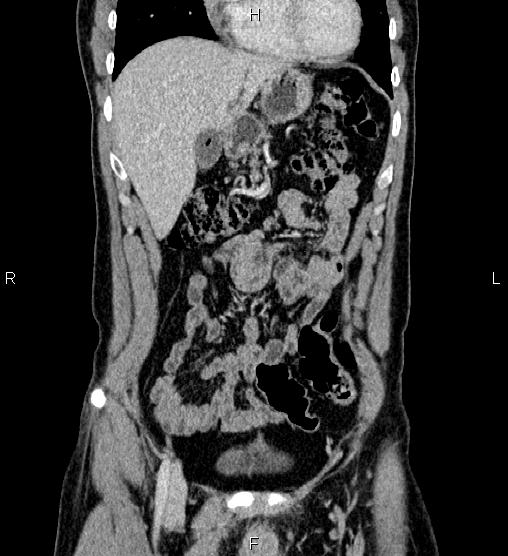 Adrenal myelolipoma (Radiopaedia 87794-104246 Coronal renal cortical phase 16).jpg