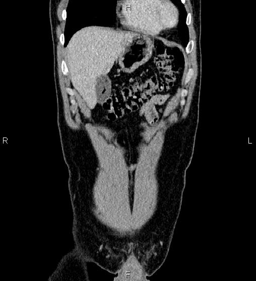 Adrenal myelolipoma (Radiopaedia 87794-104246 Coronal renal cortical phase 9).jpg