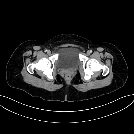 Adrenocortical carcinoma (Radiopaedia 87281-103569 Axial C+ portal venous phase 85).jpg