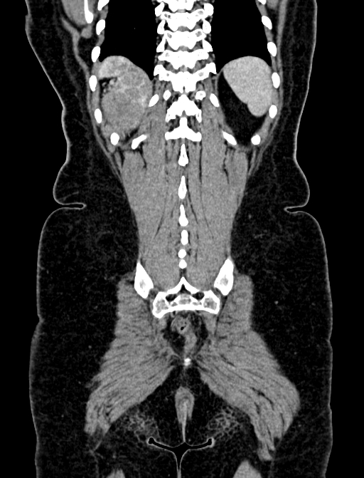 Adrenocortical carcinoma (Radiopaedia 87281-103569 Coronal C+ portal venous phase 132).jpg