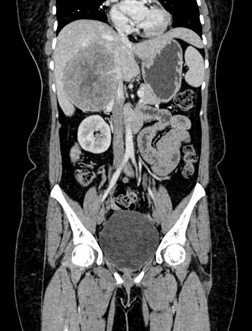 Adrenocortical carcinoma (Radiopaedia 87281-103569 Coronal C+ portal venous phase 37).jpg