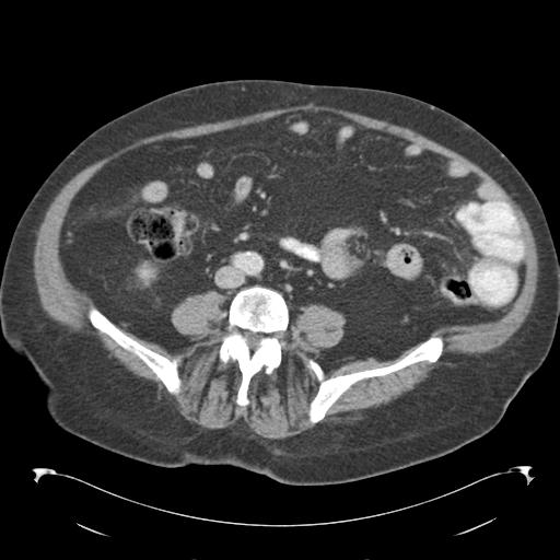 Adult ileal intussusception with secondary obstruction (Radiopaedia 30395-31051 Axial C+ portal venous phase 47).jpg