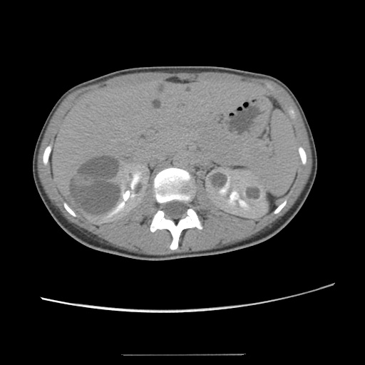 Adult polycystic kidney disease (Radiopaedia 48845-53876 Axial renal excretory phase 33).jpg