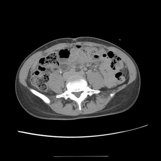 Adult polycystic kidney disease (Radiopaedia 48845-53876 Axial renal excretory phase 59).jpg